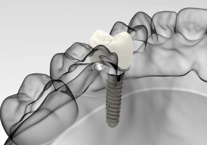 Zahnimplantate Bild 2